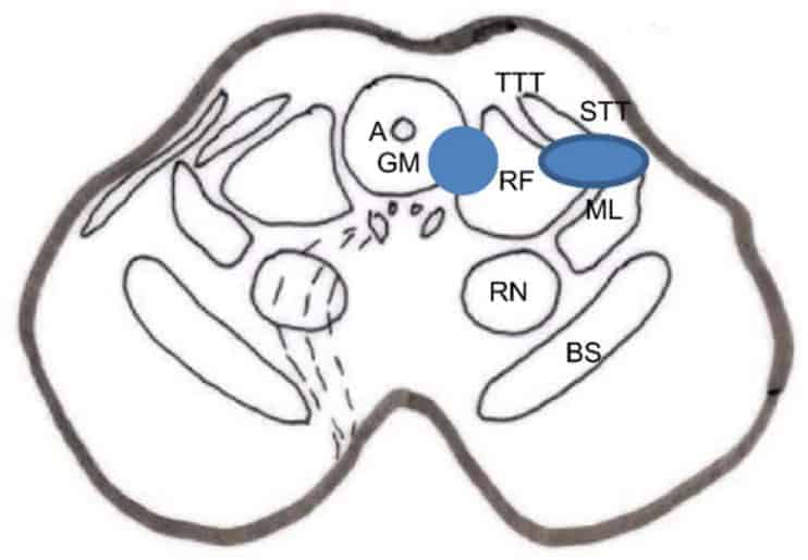 wo types of lesions proposed for stereotactic mesencephalotomy