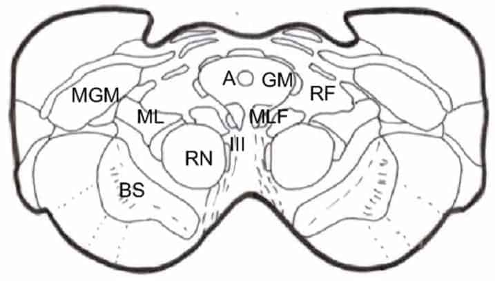 Mesencephalic section at the level proposed for mesencephalotomy
