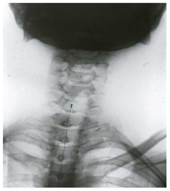 Cervical stimulation in a patient with unstable angina