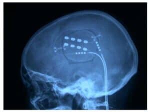 Control after placing epidural electrodes over the motor cortex