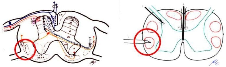 Lesion zone in the spinothalamic tract