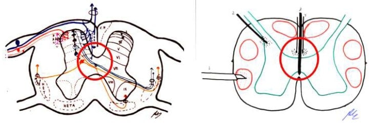 Myelotomy