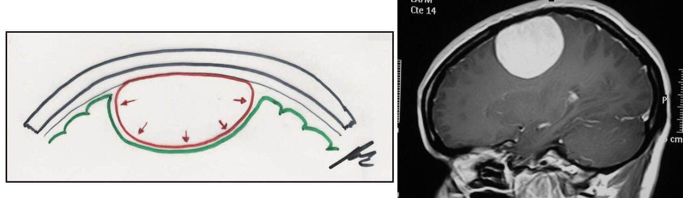 Tumores cerebrales – Escuela de Fisioterapia – CEU-Figura 1.- meningiomas y metástasis