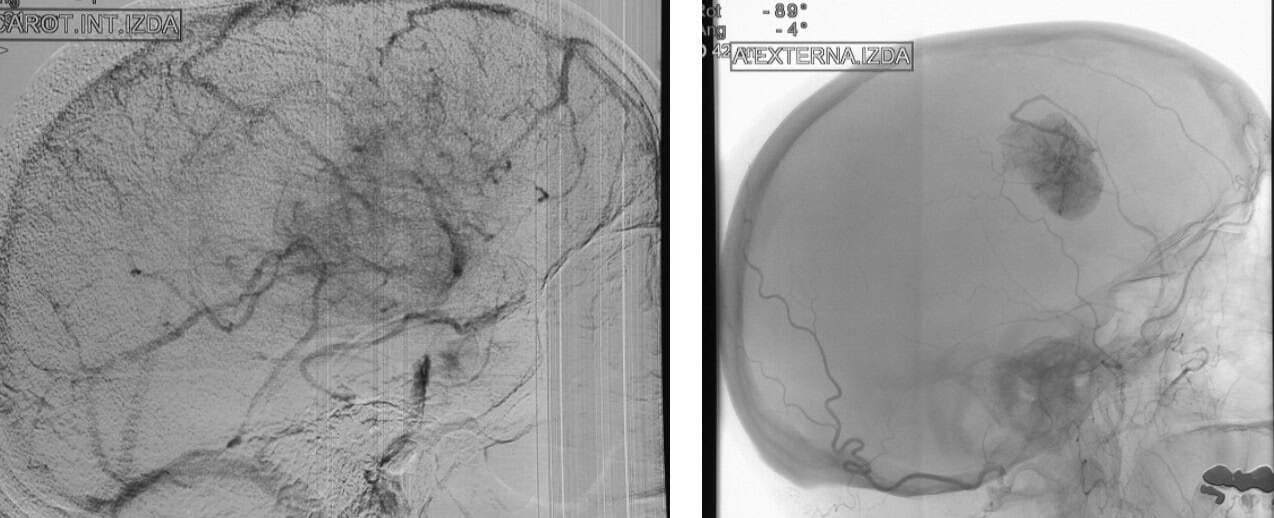 Figura 10.- tumores cerebrales arteriografia
