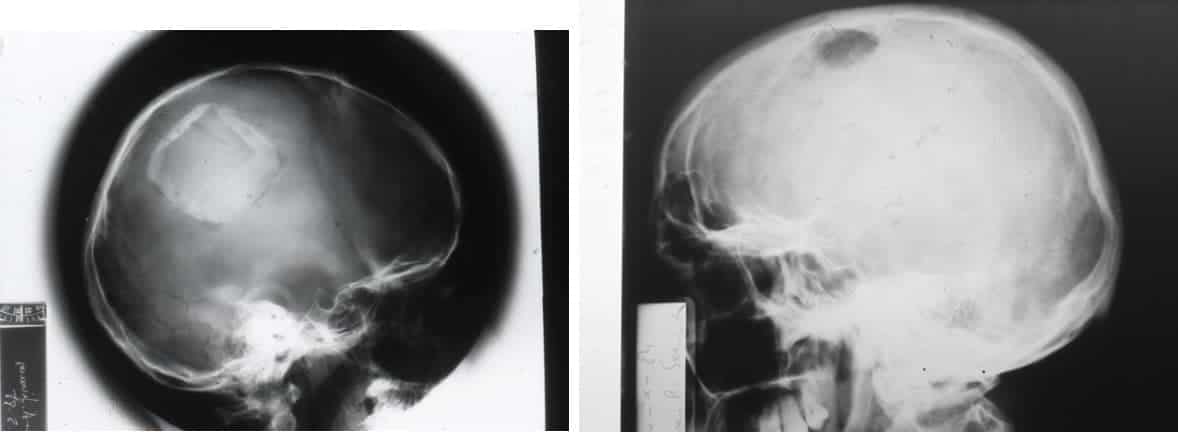 Tumores cerebrales – Escuela de Fisioterapia – CEU-Figura 11.- tumores cerebrales rx craneo