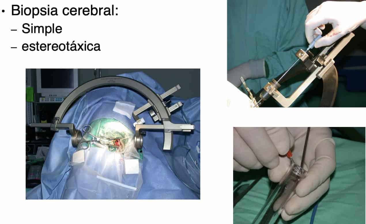 Figura 13.- tumores cerebrales tratamiento
