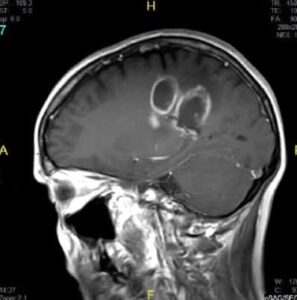 Figura 15.- tumores cerebrales gliomas