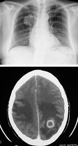 Tumores cerebrales – Escuela de Fisioterapia – CEU-Figura 16.- tumores cerebrales metastasis