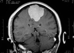 Figura 17.- tumores cerebrales meningiomas