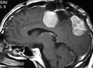 Figura 18.- tumores cerebrales meningiomas