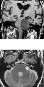 Tumores cerebrales – Escuela de Fisioterapia – CEU-Figura 19.- tumores cerebrales neurinomas