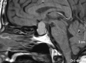 Tumores cerebrales – Escuela de Fisioterapia – CEU-Figura 20.- tumores cerebrales neurinomas Adenomas de hipófisis