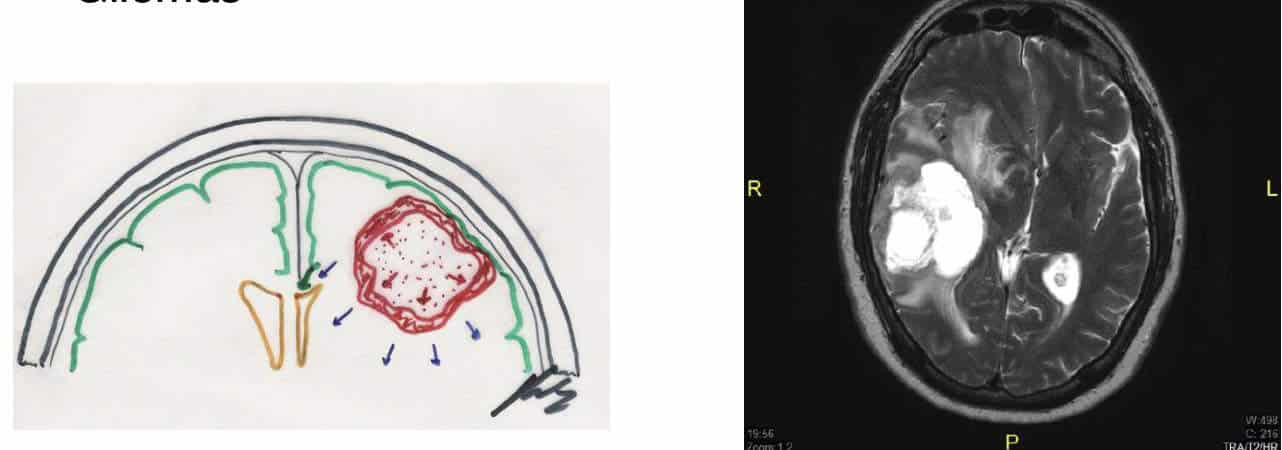 Tumores cerebrales – Escuela de Fisioterapia – CEU-Figura 3.- Gliomas
