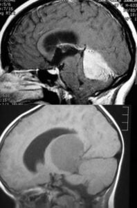 Figura 4.- tumores cerebrales clínica