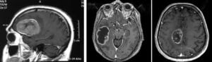 Tumores cerebrales – Escuela de Fisioterapia – CEU-Figura 5.- tumores cerebrales clínica
