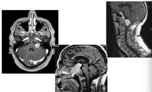Figura 6.- tumores cerebrales clínica