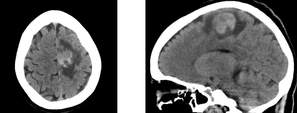 Figura 7.- tumores cerebrales diagnostico