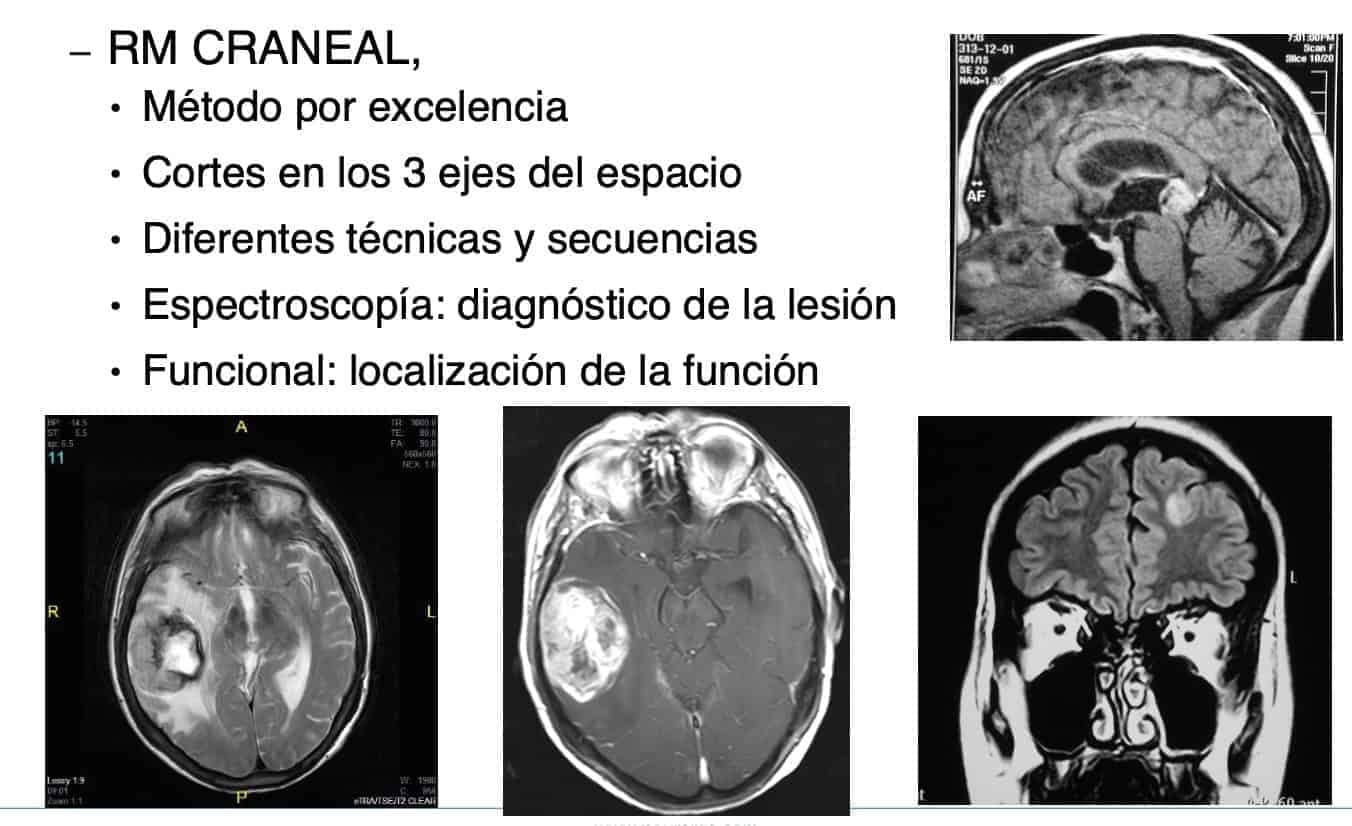 Tumores cerebrales – Escuela de Fisioterapia – CEU-Figura 8.-tumores cerebrales diagnostico