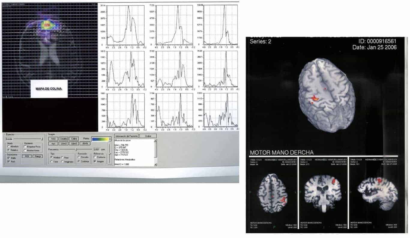 Figura 9.-tumores cerebrales diagnostico
