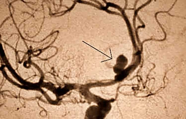 Aneurismas y hemorragias subaracnoideas