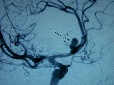 arteriografía cerebral con aneurisma