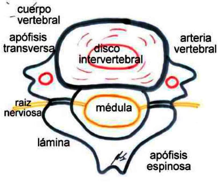 Hernia discal cervical-Visión lateral y de un corte axial del conjunto vertebra-disco, mmédula-reaíces y arterias vertebrales copia