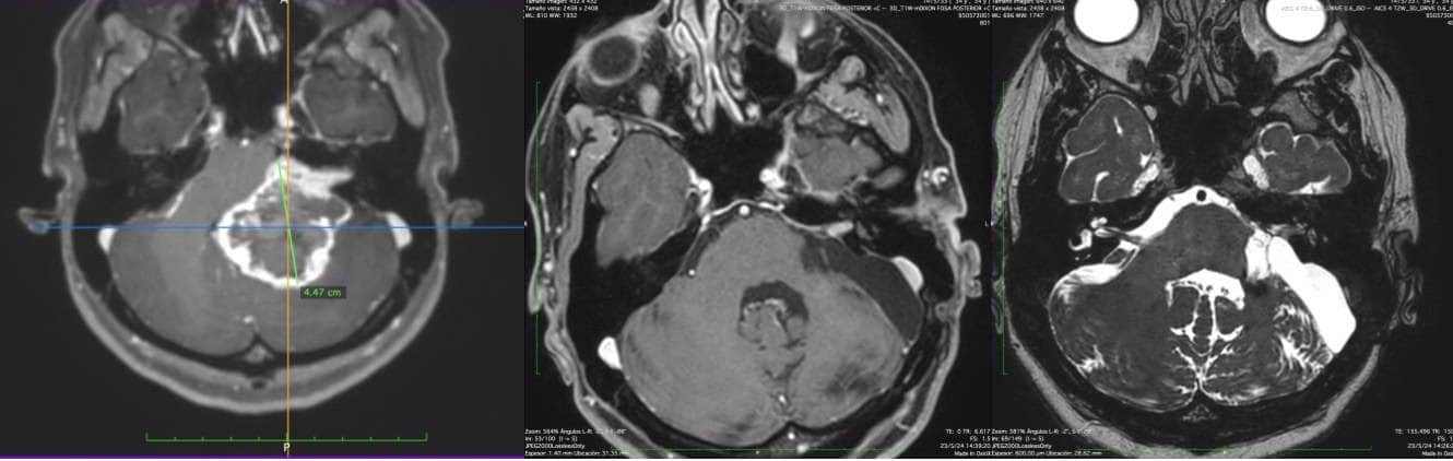 Figura 11. Imagen pre y postquirúrgica de un tumor de 4’5 cm. de diámetro. Extirpación completa (imagen central), respetando el facial (imagen de la derecha). En seguimiento la pequeña porción tumoral adherida al facial (imagen central)