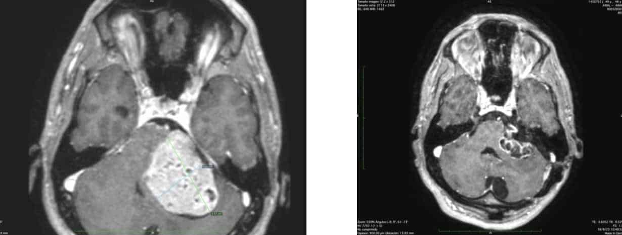 Figura 12. Imagen pre y postquirúrgica de un tumor de más de 5’5 cm. de eje mayor. Extirpación parcial, respetando el facial. En la imagen de la derecha, imagen de la tumoración muy reducida de tamaño y con los cambios post-radiocirugía al 1’5 años de seguimiento.