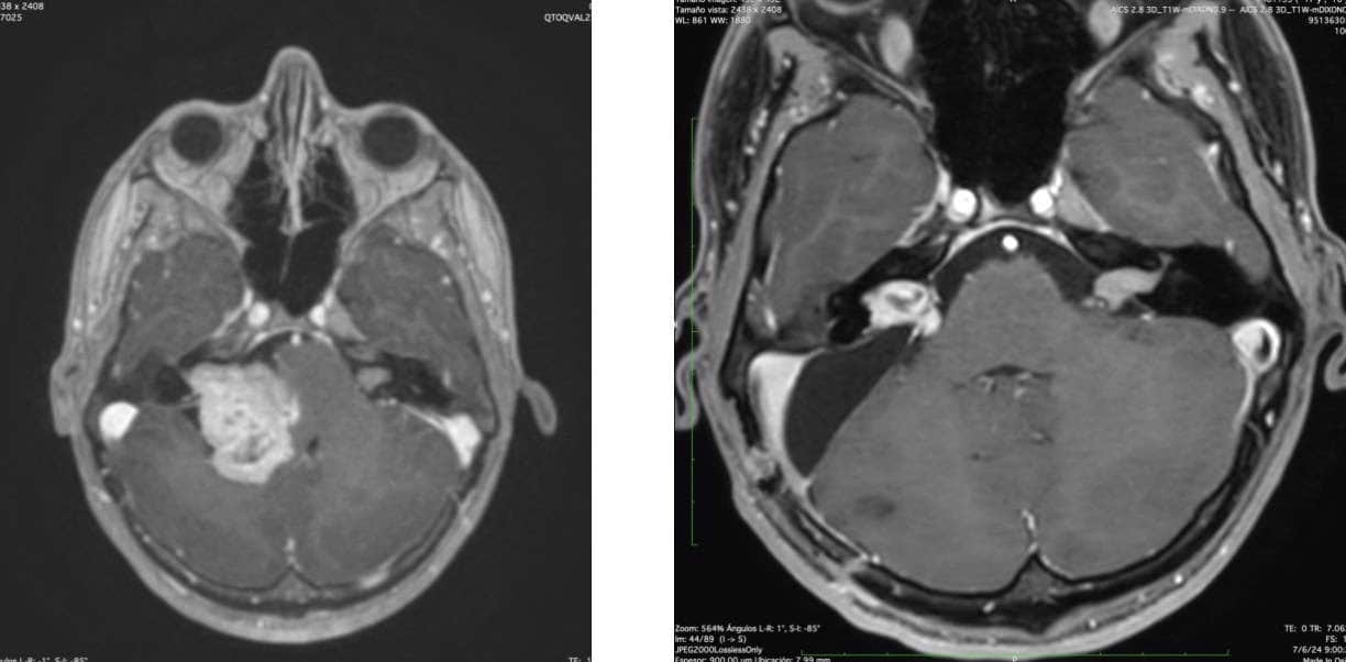 neurinoma del acústico-Figura 15.- Imagen de una RM de un paciente con Neurofibromatosis Tipo II. Con un Schwannoma Vestibular bilateral. Se intervino quirúrgicamente el de mayor tamaño (imagen izquierda), dejando un resto tumoral, para no lesionar el facial. No oía ya por lado derecho. Posteriormente ha sido sometido a tratamiento radioquirúrgico de ambos tumores. Conserva ambos nervios faciales y audición en lado izquierdo.