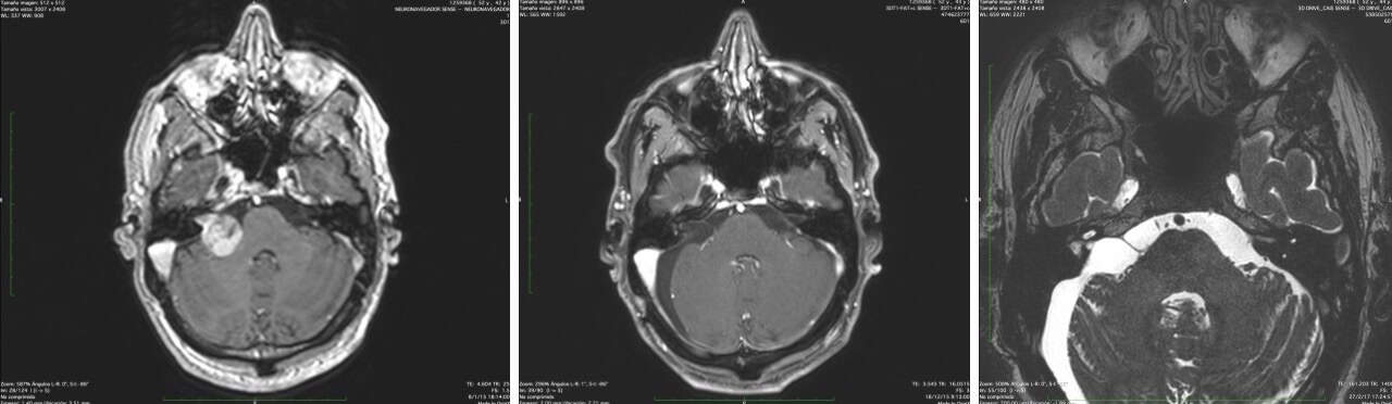neurinoma del acústico-Figura 7.- Tumoración de 2’5 cm. de diámetro. Se decidió la intervención quirúrgica. Se consigue la extirpación completa (imagen media), con respeto del nervio facial (imagen derecha). 
