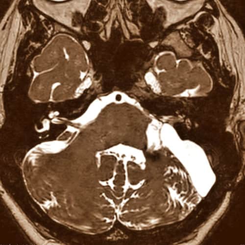 RM neurinoma-acustico