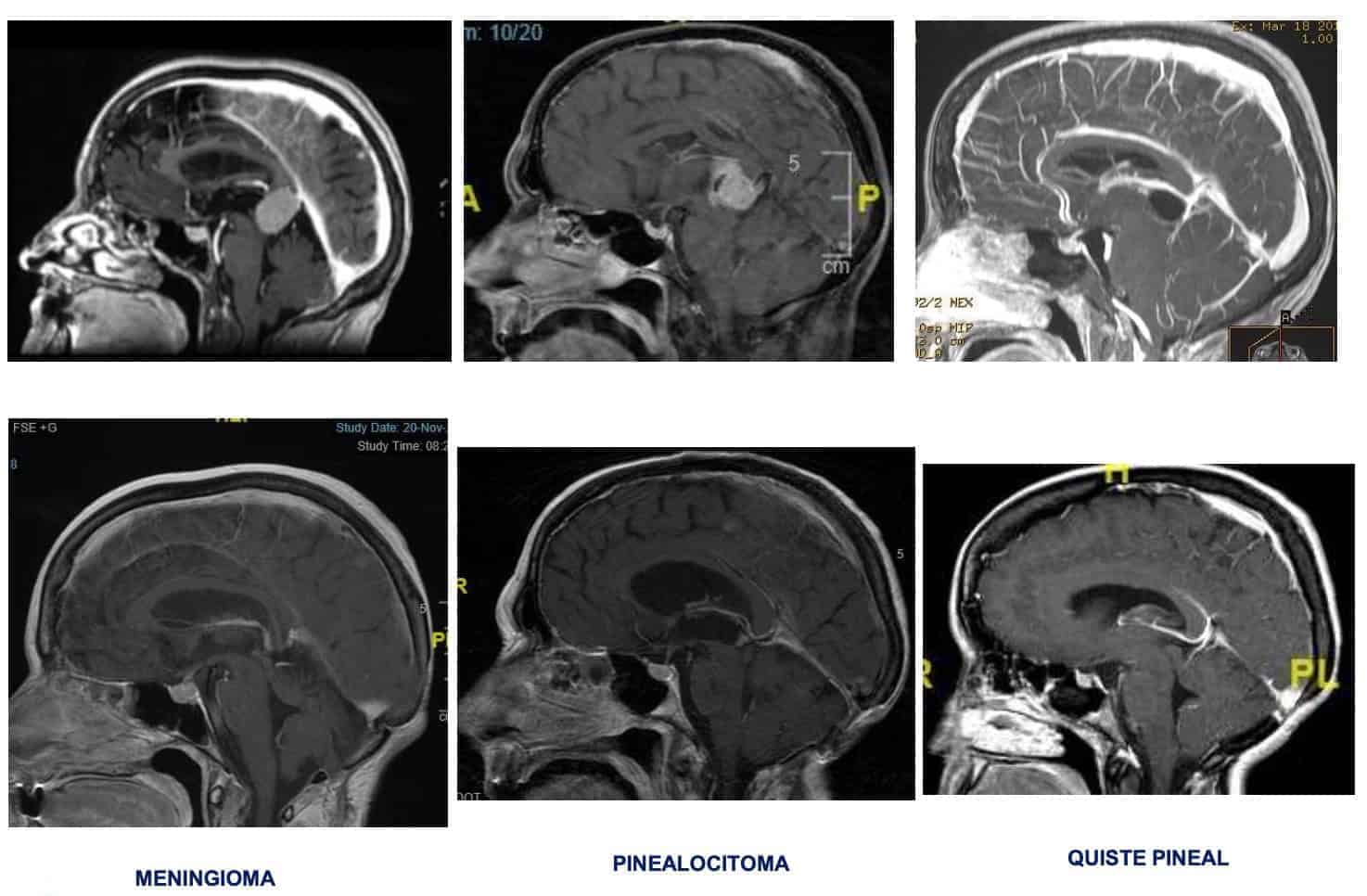 Figura 6.- Pre-post intervención quirúrgica diferentes tipo de tumores