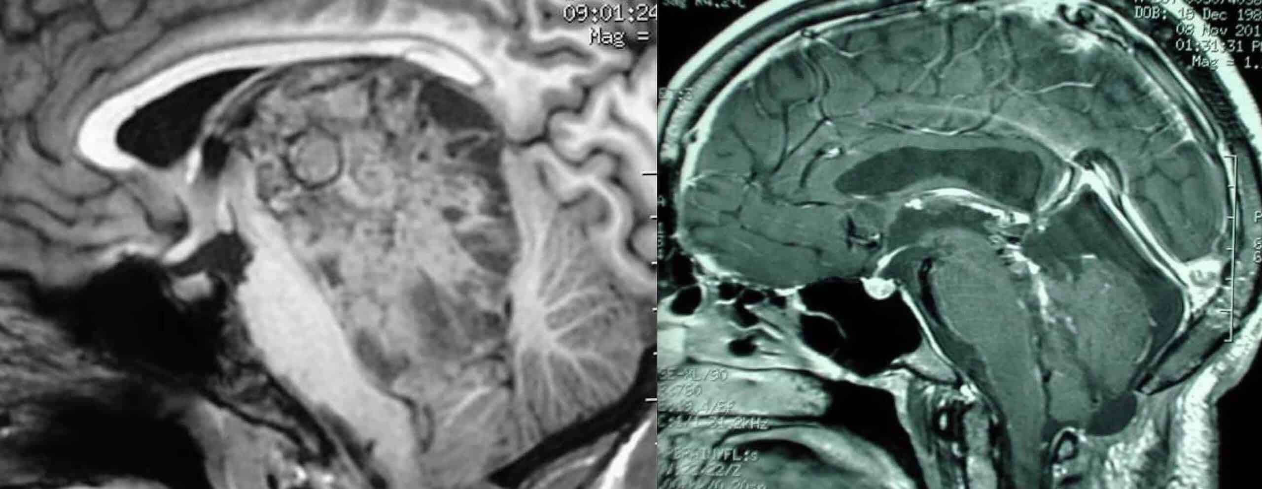 Figura 7.- Pre-post-intervención quirúrgica tumor pineal