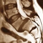 espondilolistesis lumbar L5