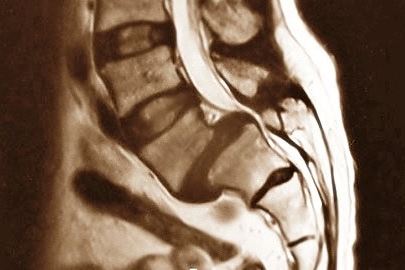 espondilolistesis lumbar L5