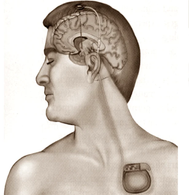 dbs-ecp-estimulacion cerebral profunda-dr. rafael garcia de sola