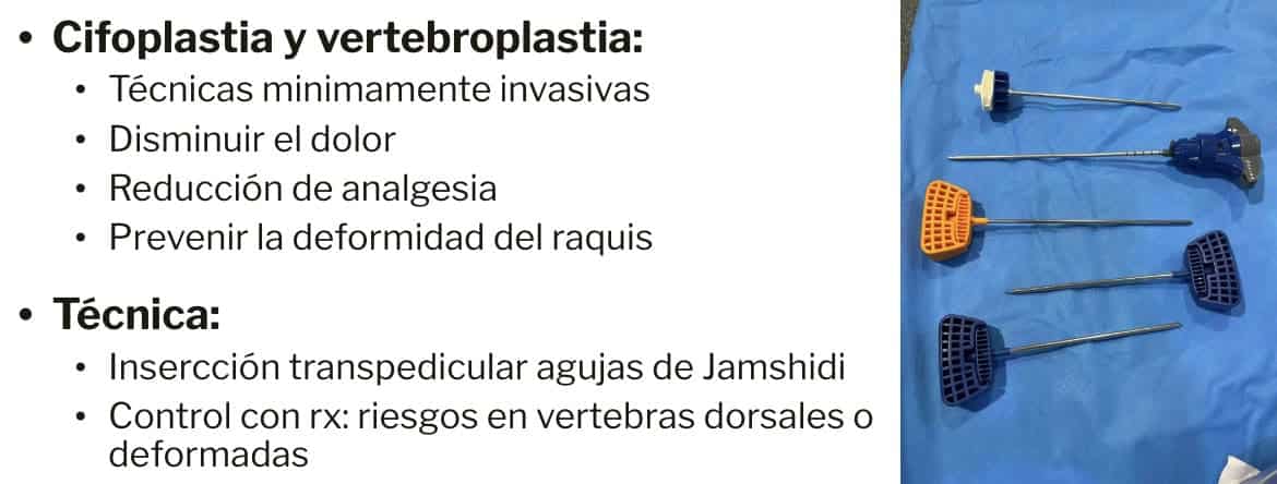 técnicas de cifoplastia y vertebroplastia