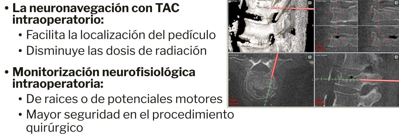 Las técnicas de neuronavegación con adquisición de imágenes 3D intraoperatoria