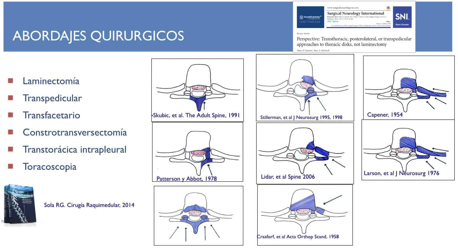  abordajes quirurgicos-hernia discal torácica
