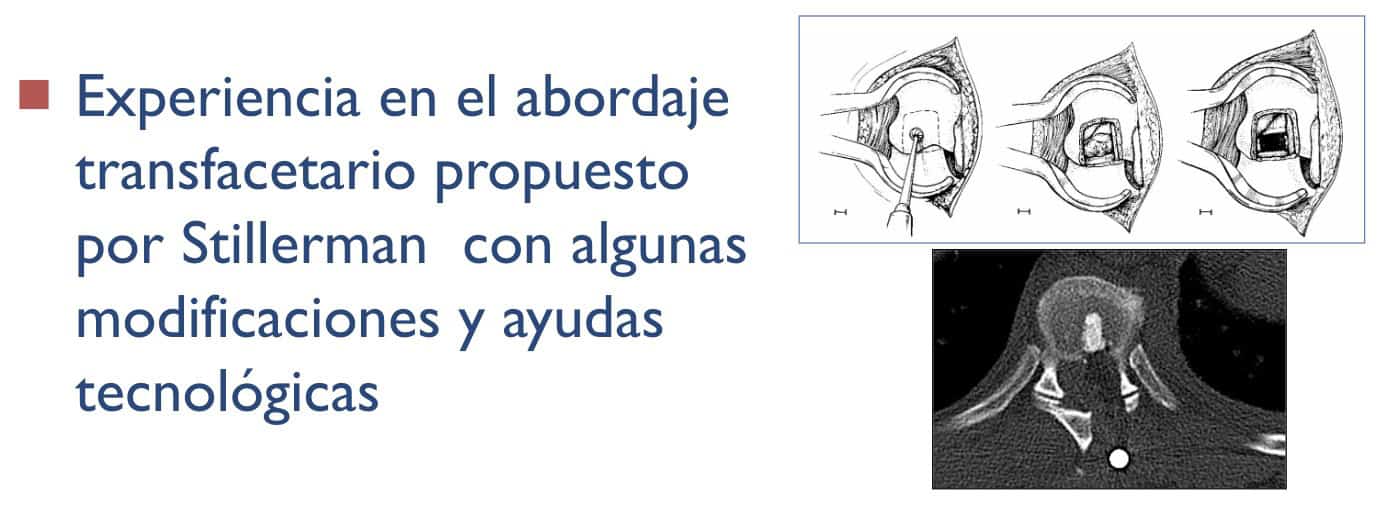 Experiencia en el abordaje transfacetario propuesto por Stillerman