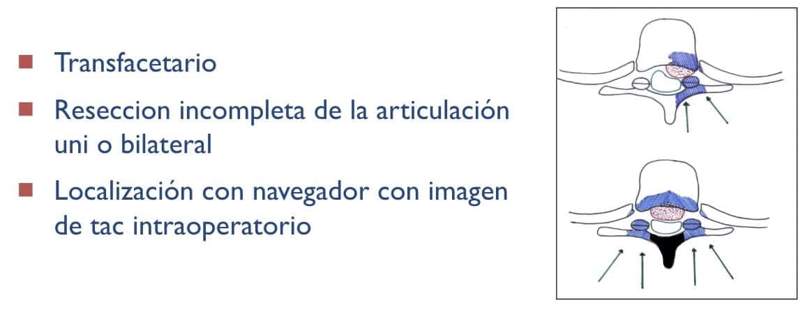 hernia discal torácica-Reseccion incompleta de la articulación uni o bilateral 