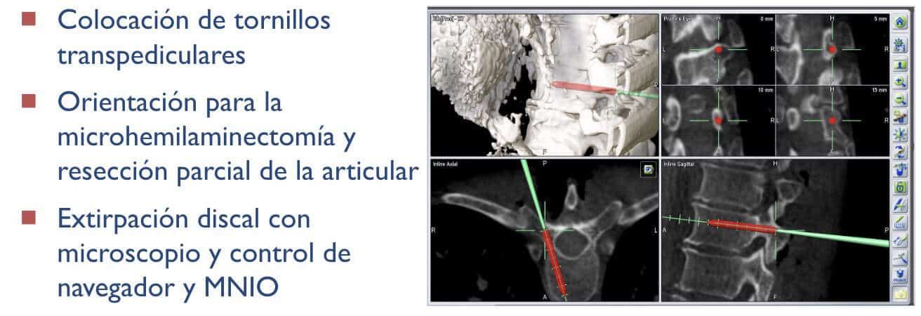 Colocación de tornillos transpediculares