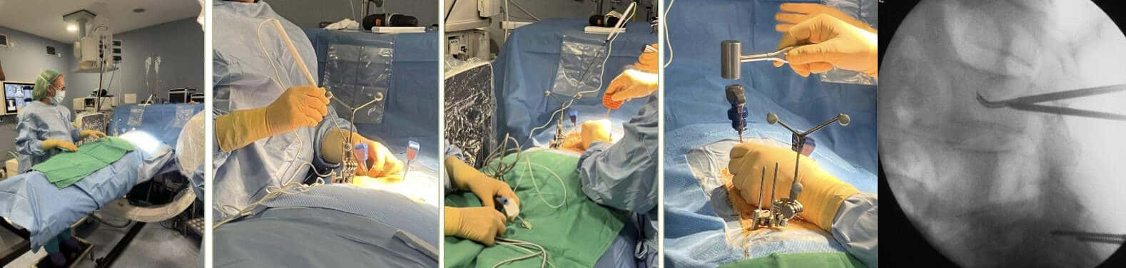 Diferentes pasos del procedimiento , control neurofisiológico, tallado de la cavidad para alojar el cemento.