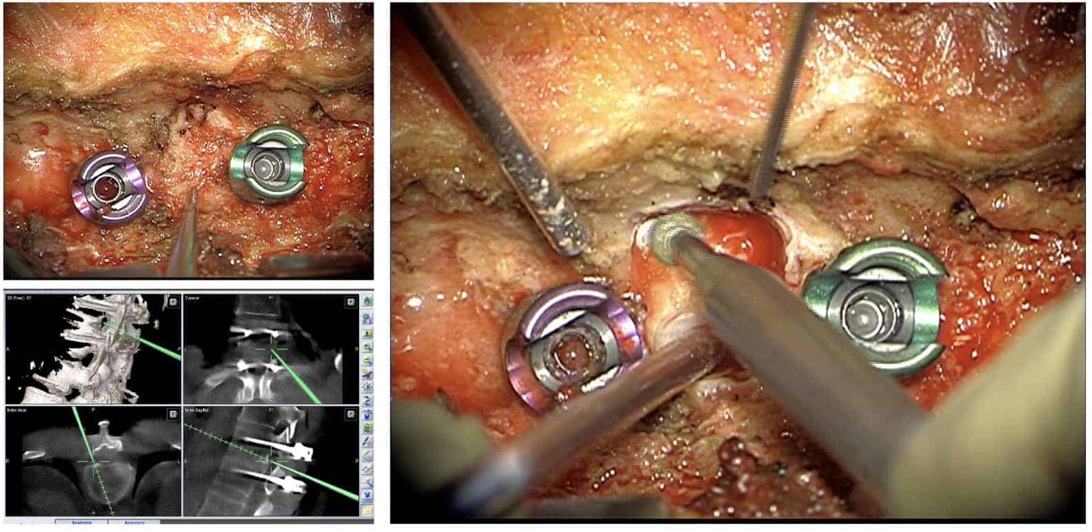 Se observan los tornillos ya implantados y como el navegador indica la posición del disco para iniciar el fresado de la hemilaminectomia
