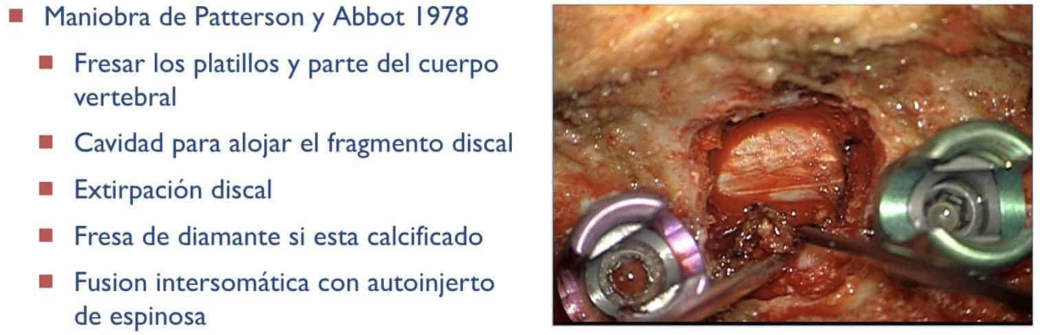 Maniobra de Patterson y Abbot 1978