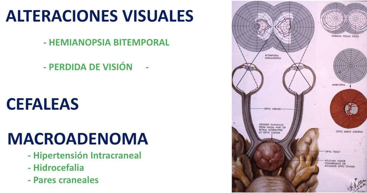 Figura 10-adenoma de hipofisis-clinica