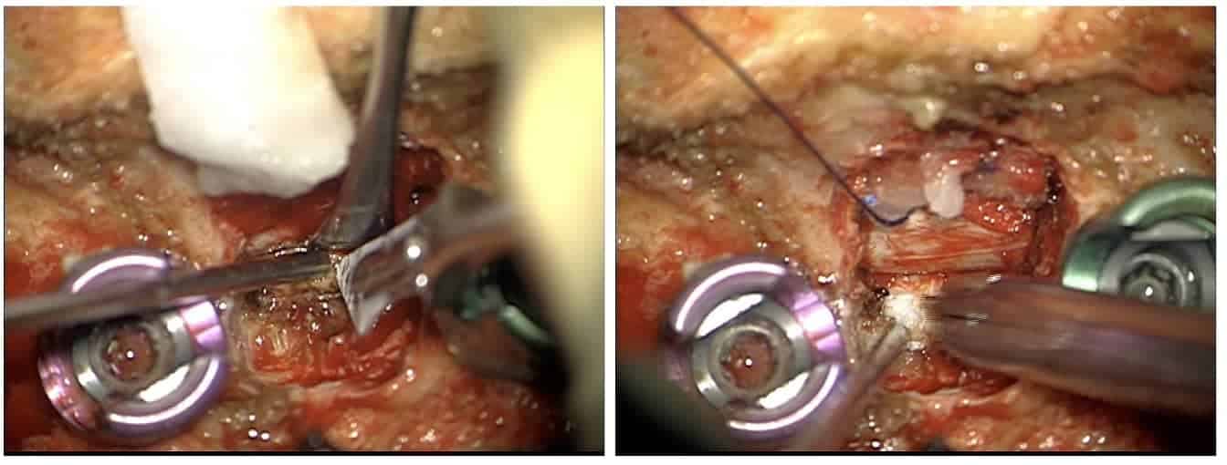 hernia discal torácica-Imagen de la extirpación del disco