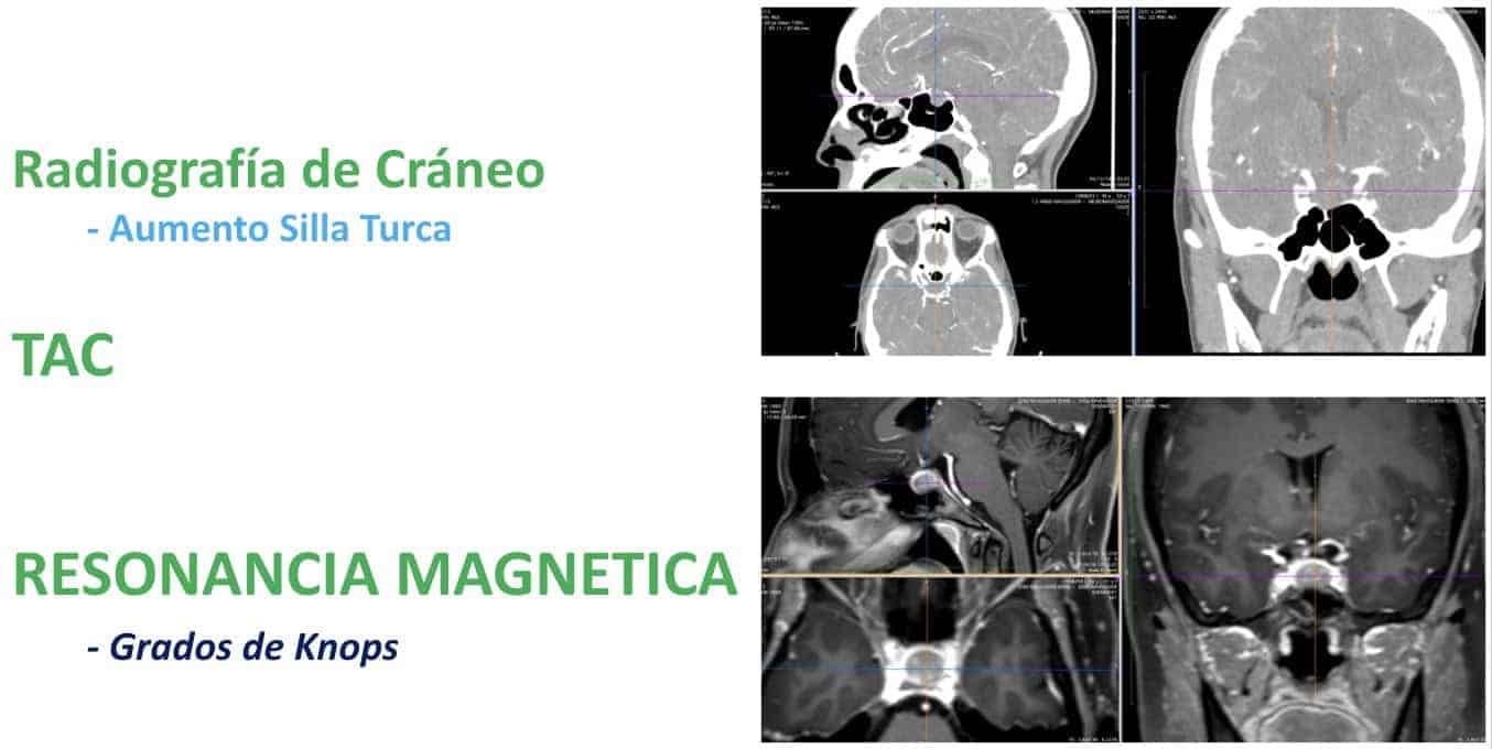 Figura 11-Hoy día el diagnóstico es relativamente fácil y rápido, gracias a la Resonancia Magnética-diagnostico