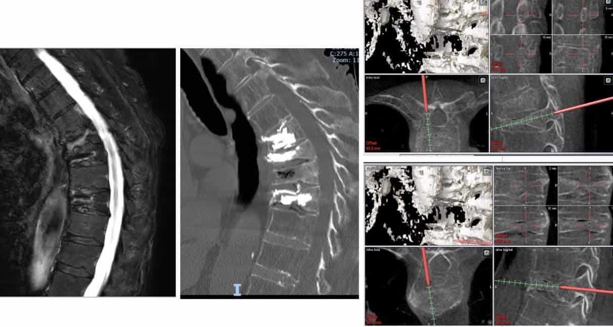 Fracturas múltiples D7-D8-D10.- En este caso existían múltiples vertebras fracturadas por lo que en el mismo procedimiento se trataron las 3 vertebras ((D7-D8-D10).