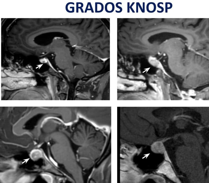 Figura 13-adenoma de hipofisis-diagnostico
